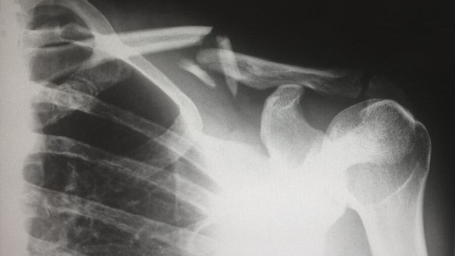 An X-ray film of a shoulder